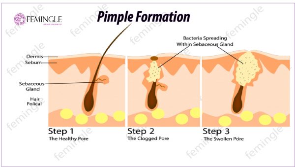 Pimple Formation