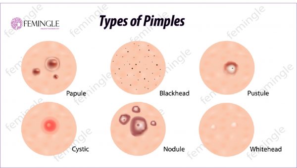 Types of pimples